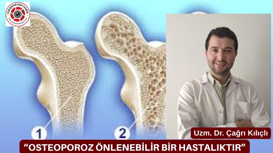 OSTEOPOROZ NLENEBLR BR HASTALIKTIR